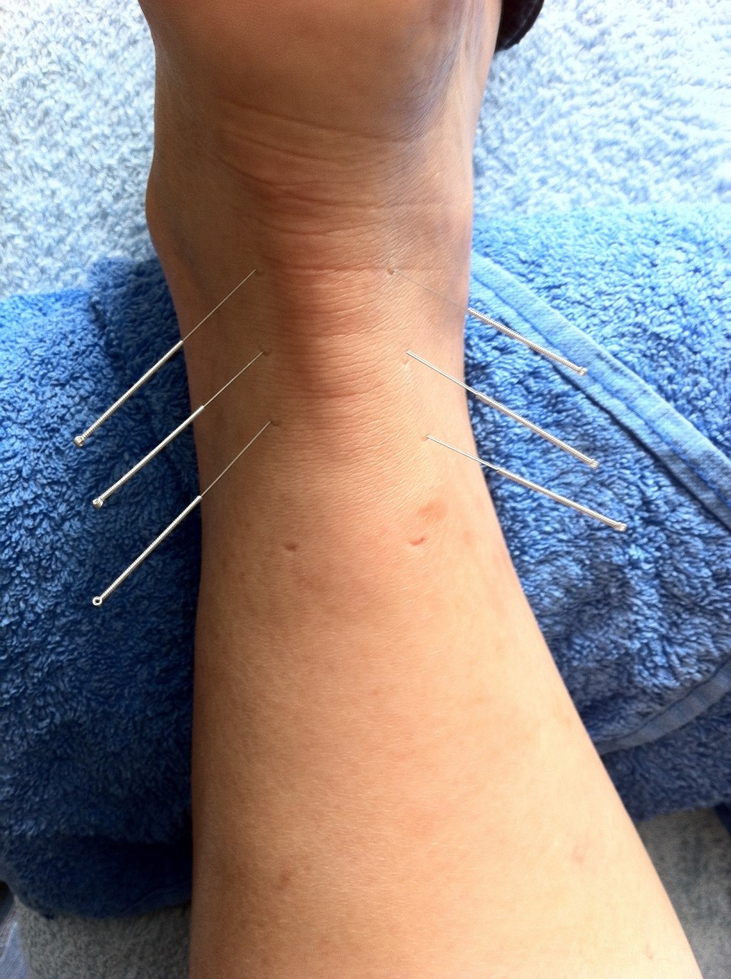 Dryneedling, la nuova frontiera della fisioterapia. ma cos’è?