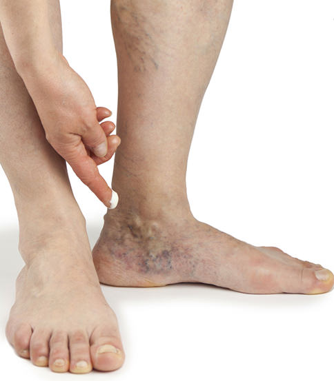 Occhio ai capillari sulle caviglie.