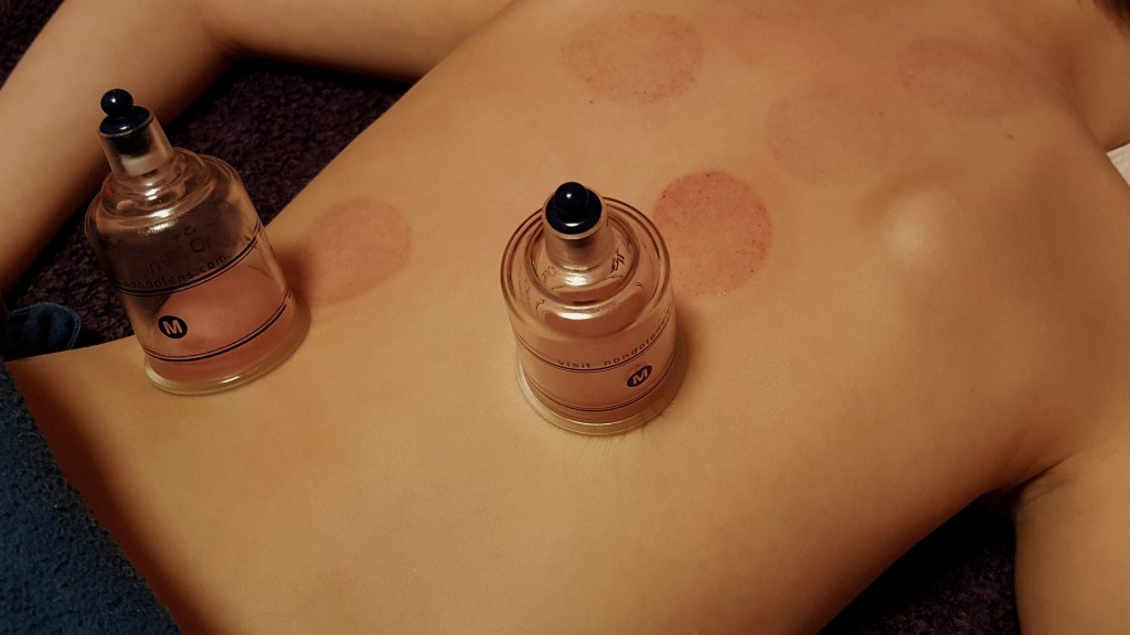 LA COPPETTAZIONE O CUPPING THERAPY PER IL TRATTAMENTO IN FISIOTERAPIA. PERCHE’ USARLA E QUALI&nbsp;BENEFICI?