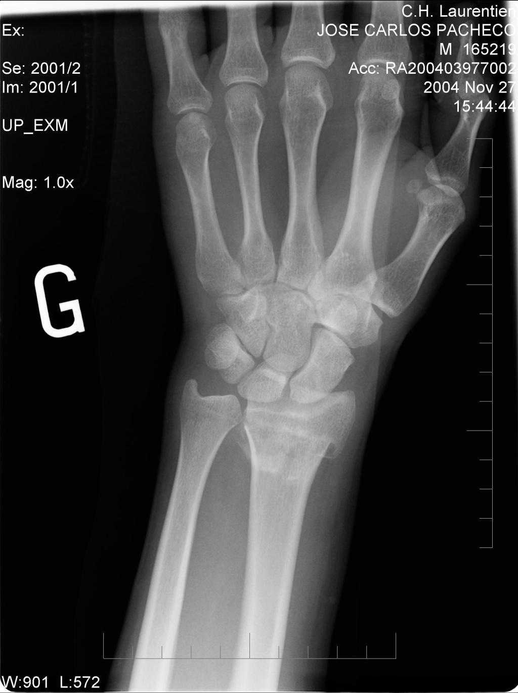 TENOLISI E FRATTURA DI RADIO, CHE LEGAME C’E’?