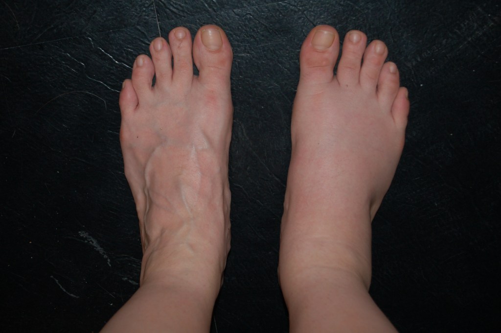 LA SINDROME ALGONEURODISTROFICA, UN LUNGHISSIMO PAROLONE PER DIRE&nbsp;COSA?